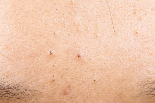 blackheads
