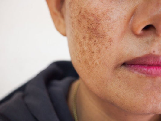 Understanding Hyperpigmentation and How to Treat It